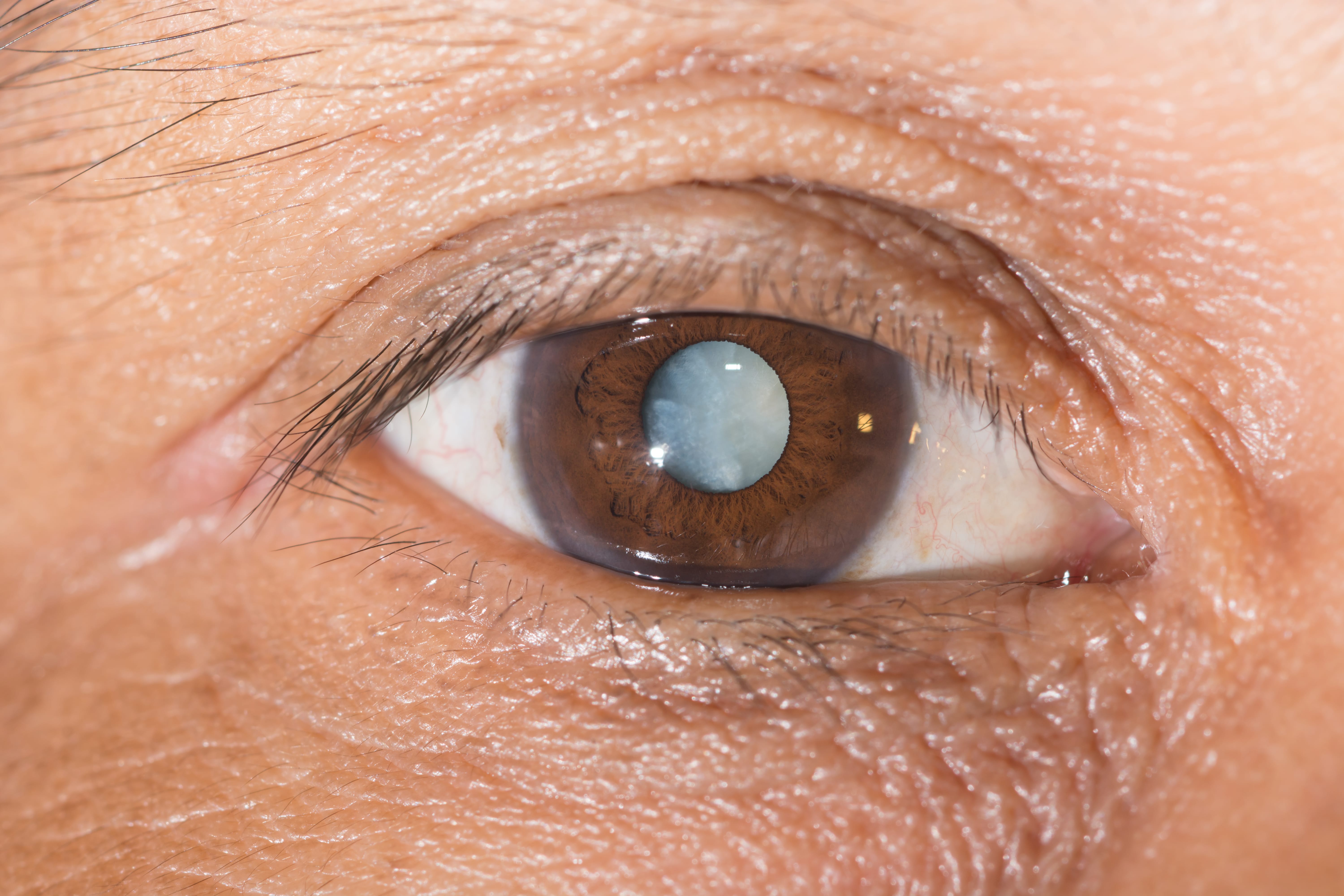 Что можно делать после катаракты. Контузионная катаракта. Старческая(сенильная)катаракта. Сенильная диабетическая катаракта.